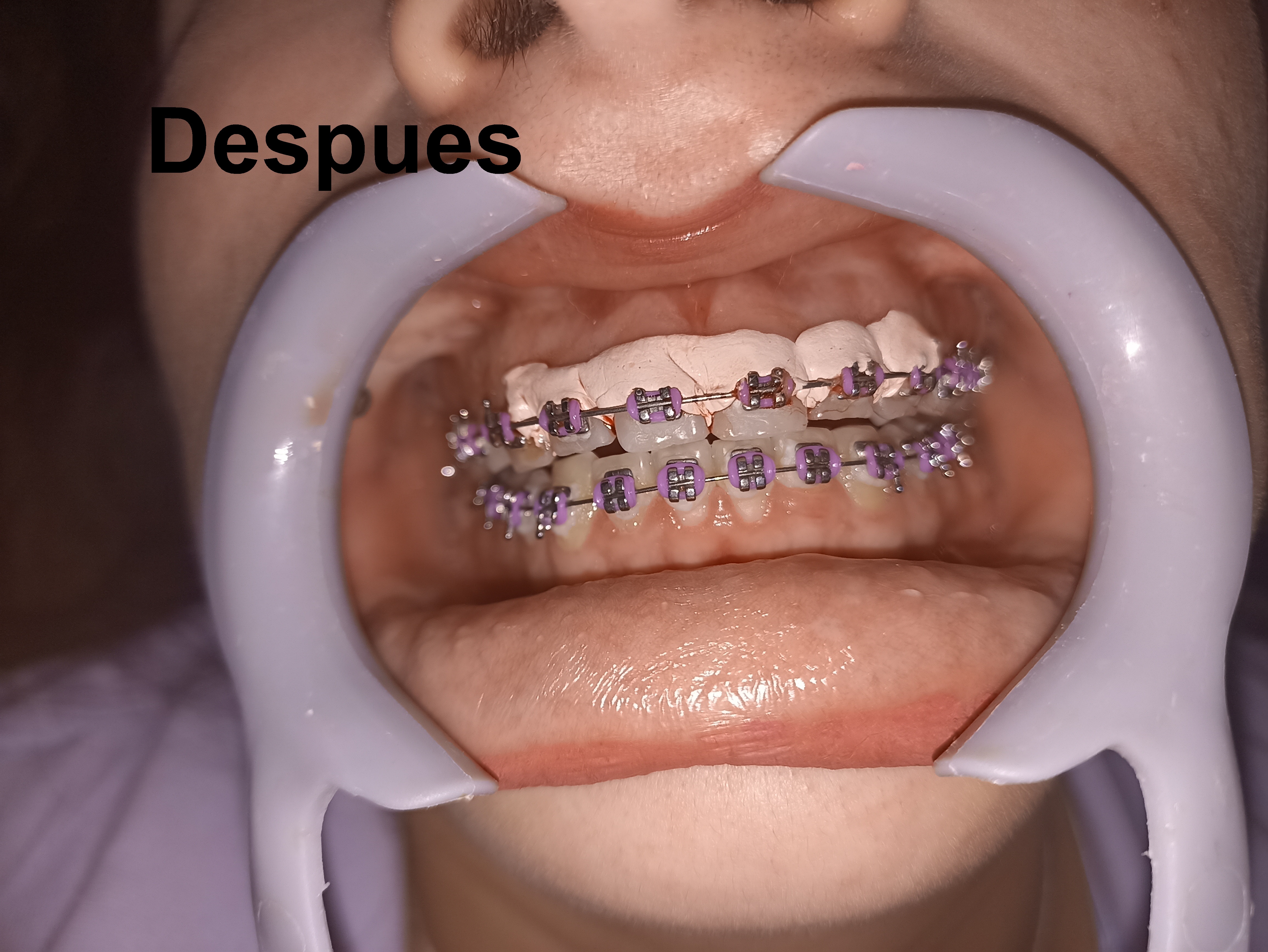 Después del tratamiento