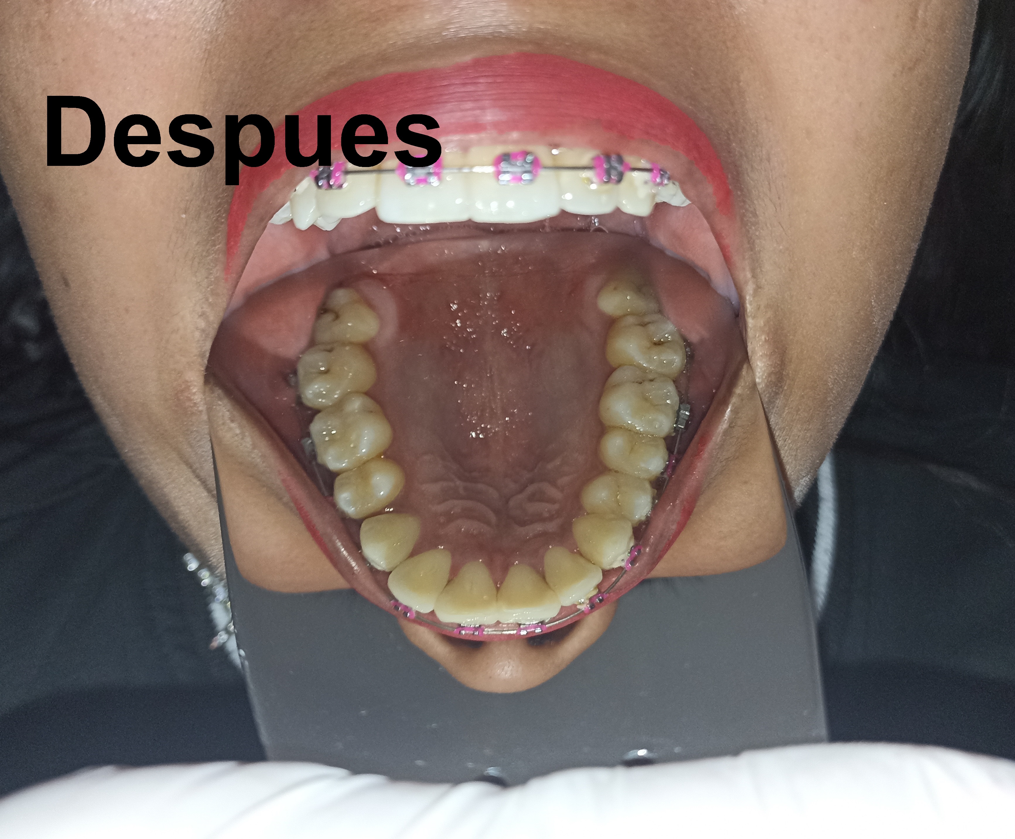 Después del tratamiento