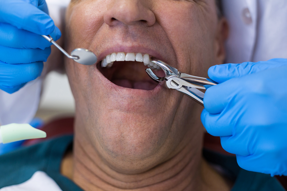 Extracción dental